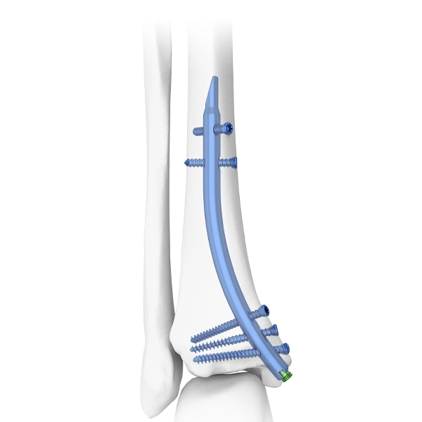 DTN Distal Tibial Nail